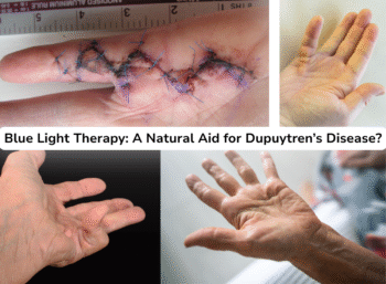 Blue Light Therapy A Natural Aid for Dupuytrens Disease