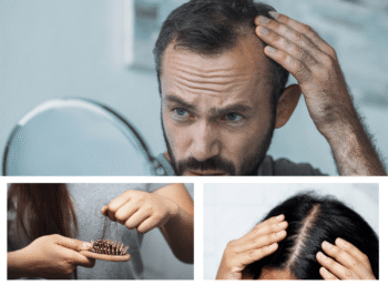 Hair Loss Reversed How Red Light Therapy Doubled Hair Density in 5 Weeks!