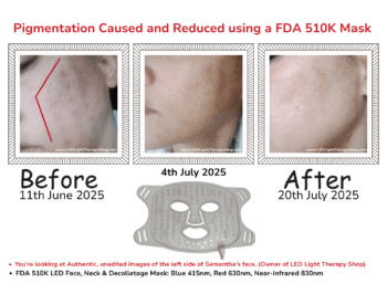 3 images before and after pigmentation caused and cleared using led face mask fitzpatrick type 2-3 skin authentic real results blog My Mixed-Race Skin Pigmentation LED Mask The Gold Standard is WRONG For Some Skin Types